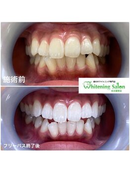 ホワイトニングサロン 名古屋駅店/【ホワイトニング施術例】