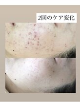 スキンプローズ(skinprose)/お顔ハーブピーリング・ハード