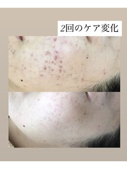 スキンプローズ(skinprose)/お顔ハーブピーリング・ハード