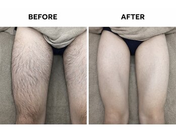 自由が丘ダツモウセンター(自由が丘 DATSUMOW CENTER)/脚脱毛～男性～