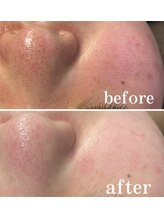 オーシャンブルー 長崎店(OCEAN BLUE)/プレミアムフェイシャル症例