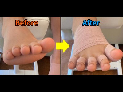 浮き指・足首の緩み・歩行時の不安定性を解消