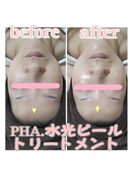 ピュルテ/水光ピールで毛穴レスな艶肌へ