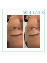 スキン ラボ ケー(Skin lab K)/低温プラズマ+リジュランケア