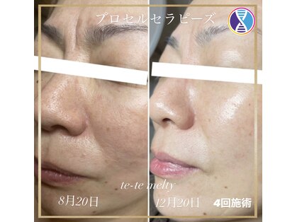 テテメルティ(te-te melty)の写真
