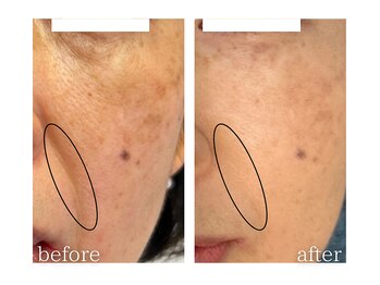 モニ 福岡(Moni)/ハーブピーリング で シワケア