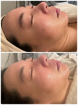 ピピ 三軒茶屋(pipi)/フラワーハーブピーリング