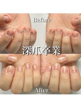 リリー/深爪卒業！