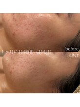 アール(ar.)/ニキビケアフェイシャル