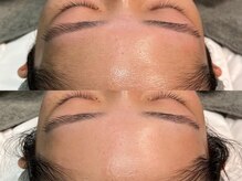 オパール 大阪梅田(op_l)/梅田/毛穴洗浄/フェイスワックス