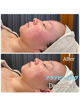 エクセレントビューティーサロン 艶(EN)/アクアピーリング&ダクトピール