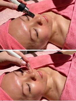 なちゅら(Nachula)の写真/満足度当店No.1の毛穴洗浄！【毛穴洗浄＋超音波洗浄】は毛穴洗浄歴20年以上のなちゅらにお任せ下さい！