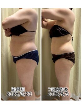 クールスパ(COOL SPA)/50代女性お腹症例