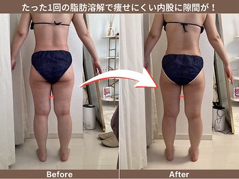 ゼロ シロカネ(ZERO SHIROKANE)の写真/【40代～自分磨き】最新痩身マシンで下半身のセル脂肪を分解&燃焼★下半身集中コース120分￥22000→￥10900