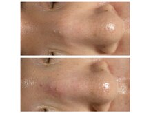 アンス(Ance)/毛穴洗浄ビフォーアフター♪1回!