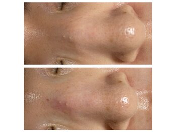 アンス(Ance)/毛穴洗浄ビフォーアフター♪1回!