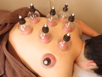 住吉鍼灸院アネックス/吸角（吸い玉、カッピング）