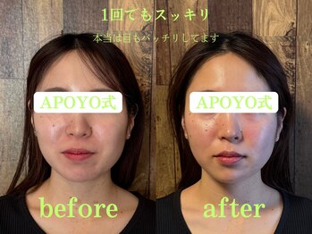 アポヨ鍼灸院(APOYO鍼灸院)/美容鍼　before/after