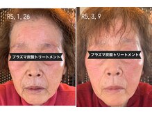 サロン フェリシア(salon Felicia)/80代女性Before/After