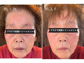 サロン フェリシア(salon Felicia)/80代女性Before/After