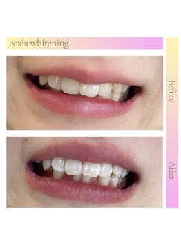 エクシアホワイトニング 天王寺店/ホワイトニングビフォーアフター