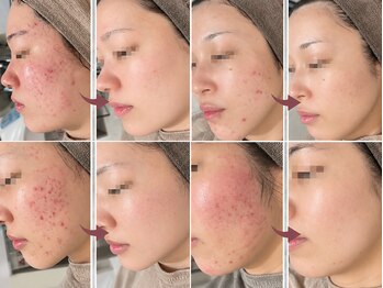 アイルーム(i.room)の写真/繰り返すニキビ・毛穴・肌荒れに◎その場しのぎではなく肌質から整える♪