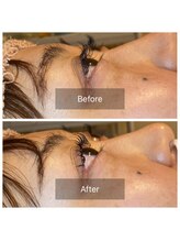 ラディアンス/エクパーマ/パリエク（LED装着）