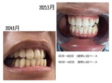 レイズ(RAISE)/セルフホワイトニング経過写真