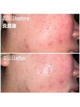 ミニョン(mignon)/市販のクレンジング、、