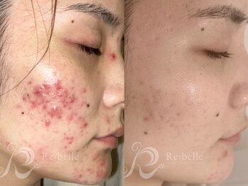 ビスキン(BeSkin)の写真/【皮脂汚れ/シミしわ/ニキビケア】に肌質から改善するハーブピーリング♪繰り返させないニキビケア◎