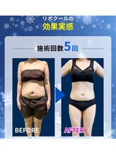 エステティック らぽーる(Rapport)/脂肪冷却マシン