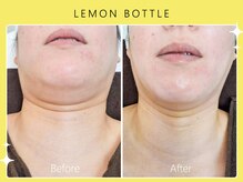 シロカネ イオンタウン西熊本店(SHIROKANE)/レモンボトル☆