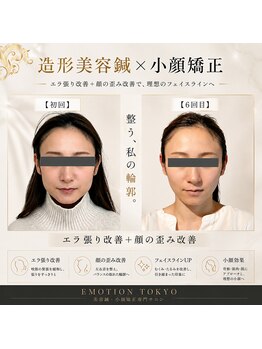 エモシオン トウキョウ(EMOTION TOKYO)/造形美容鍼×小顔矯正