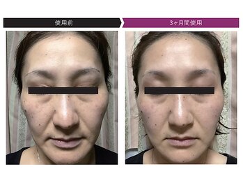 パーフェクトフェイスビューティー 梅田店(PERFECT FACE BEAUTY)/ディレイアコスメ（3種）使用