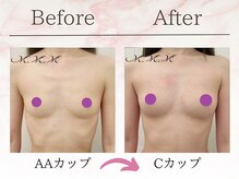 エムエムエム 表参道Luxeサロン(M.M.M)/【バストアップ例】AA→Cカップ
