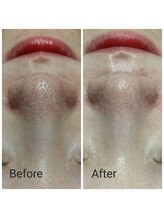 サロン ピューパ(Salon pupa)/女性毛穴洗浄　before→after