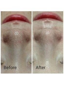 サロン ピューパ(Salon pupa)/女性毛穴洗浄　before→after