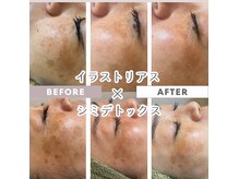 シミで悩んでいませんか？