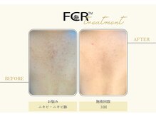 ハーバル 新宿店(HERBAL)/最強★韓国FCRハーブピーリング