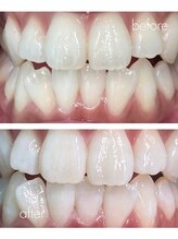 ルミナ(LUMINA)/ホワイトニングで輝く歯を