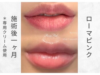 芯美 恵比寿店(shinbi)/ローマピンク施術後1ヵ月