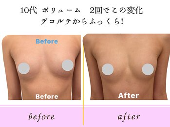 ビーハピネス 京都西院(B-Happiness)/10代ボリュームのお悩み