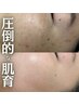 【小顔×肌管理】リアボーテ／毛穴・シミシワ改善・ニキビケア・肌を変えたい