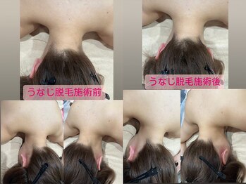 るあん/うなじ脱毛Before&After