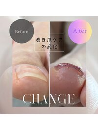 巻き爪ケアフット
