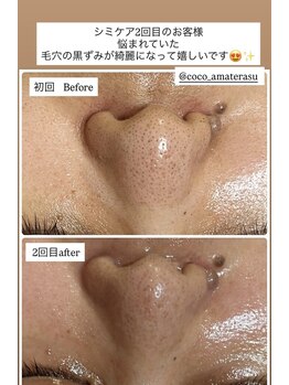 ココ(COCO)/シミケア、ビフォー、アフター