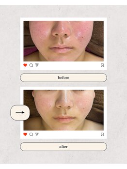 ヨサ モア(yosa more)/BeforeAfter