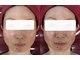 メディカルサロン かとれあの写真/[リフティングZERO]手の温もりが導く新発想リフト　
リピート率No. 1の心まで軽くなる極上リフティング術