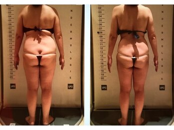 ビューティースパ/お悩みNO.1凸凹セル脂肪