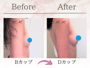 エムエムエム 表参道Luxeサロン(M.M.M)/【バストアップ例】　B→Dカップ
